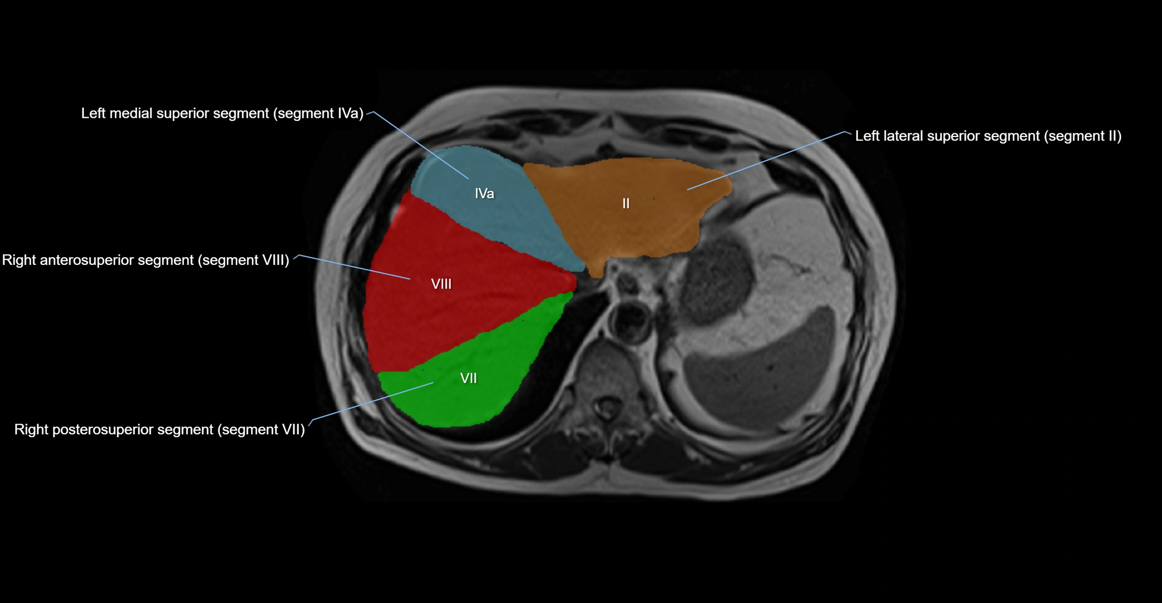MRI  liver segments anatomy axial cross sectional 3T radiology  image-img-00001-00007.webp